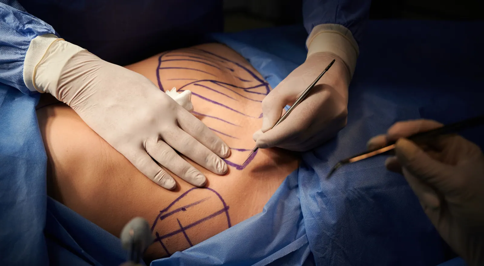 Body Contouring
