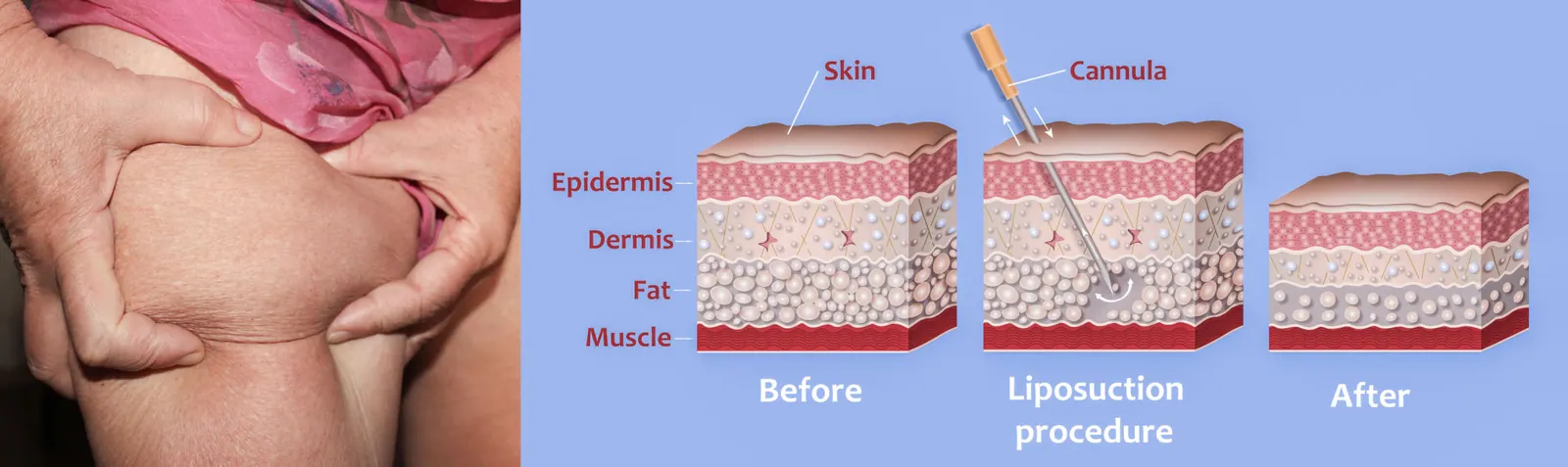 Liposuction