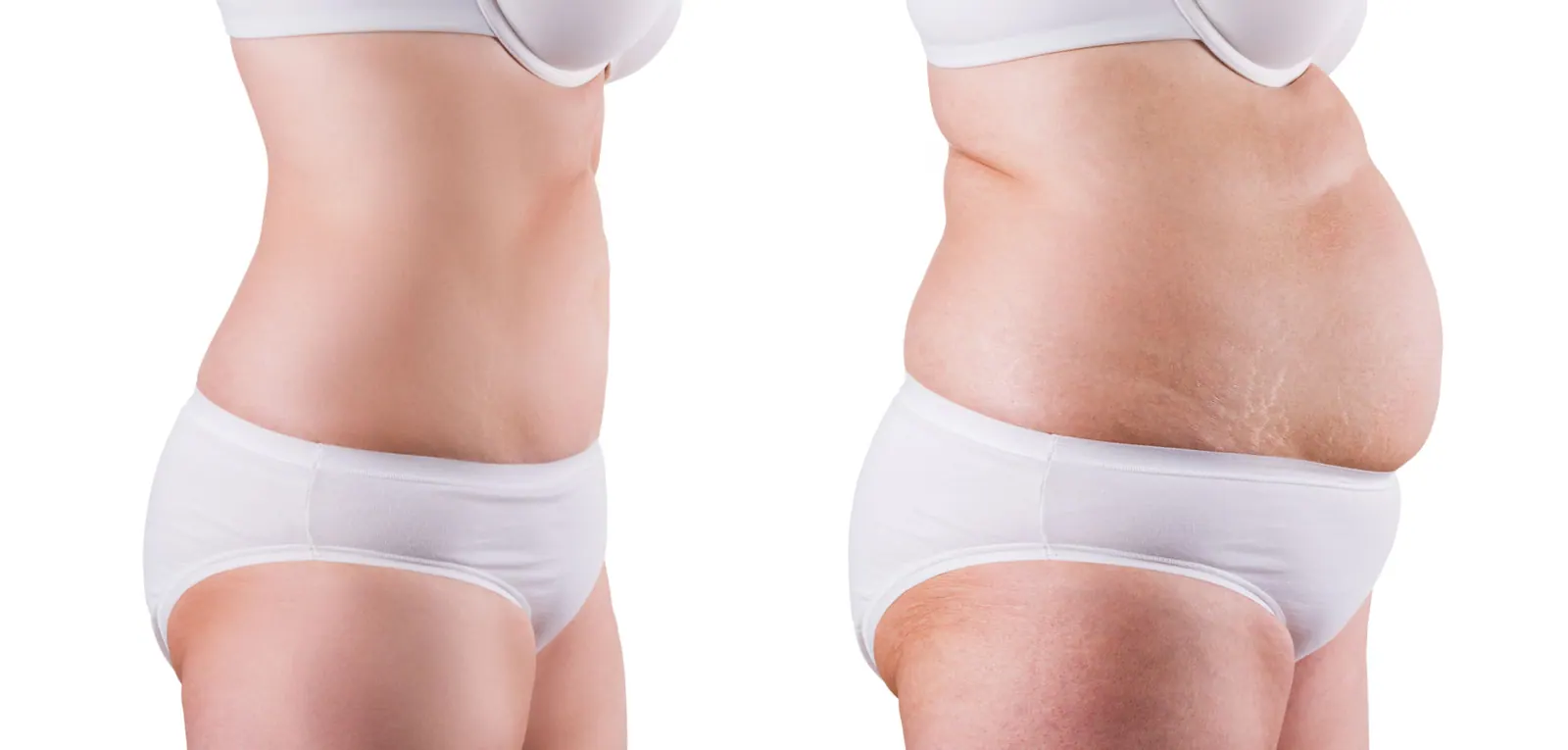 Tummy Tuck