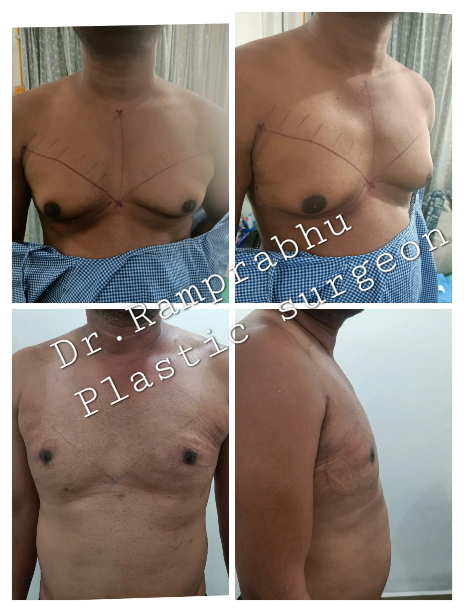 Before and after gynecomastia surgery results