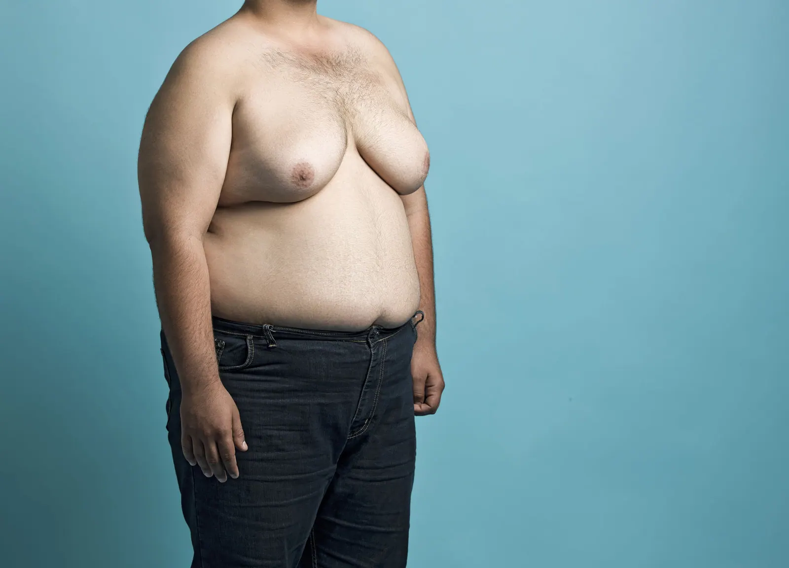 Gynecomastia