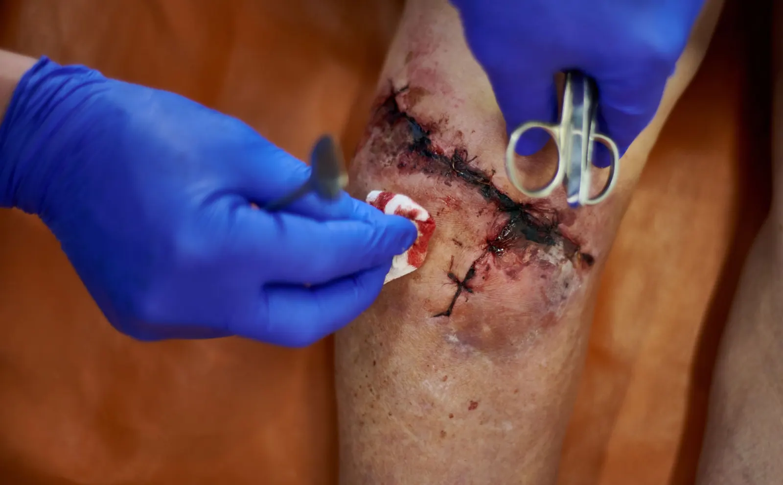 Post-Trauma Reconstruction